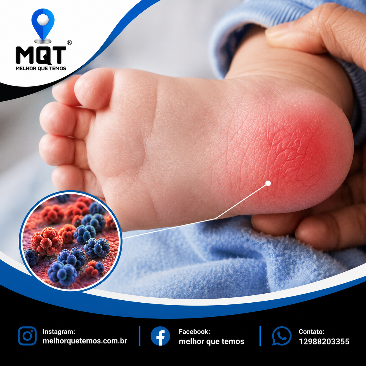 CELULITE INFECCIOSA EM BEBÊS