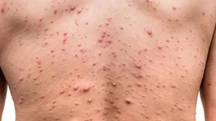 Mpox em Ribeirão Preto